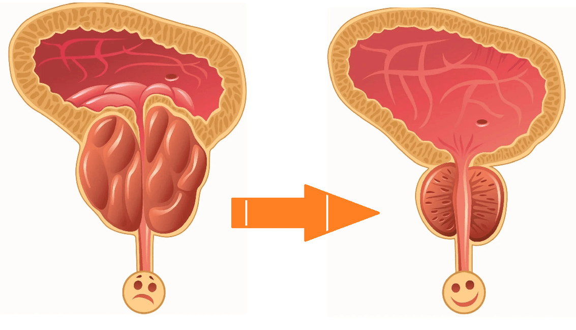 Action Uromexil Forte sur la prostate avec prostatite et adénome