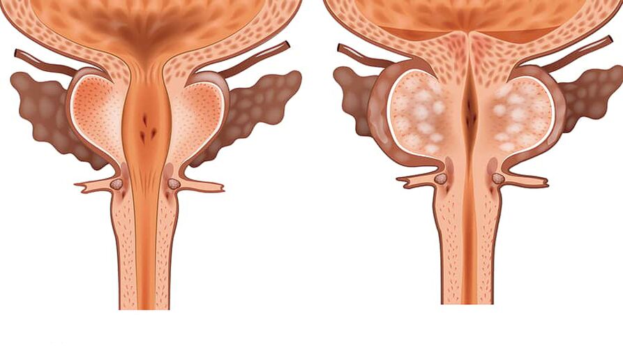 comparaison d'adénomes sains et inflammatoires