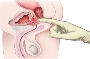 Massage de la prostate pour le traitement de la prostatite chronique