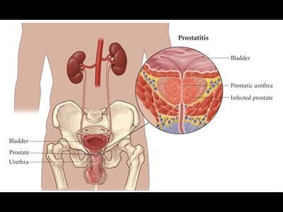 Prostatite – inflammation de la prostate
