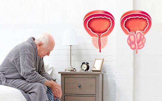 prostatite chez un homme